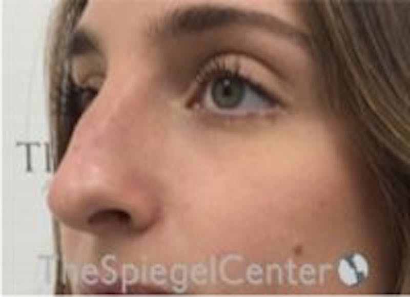 Non-Surgical Rhinoplasty / Nose Filler Before & After Gallery - Patient 283814 - Image 3