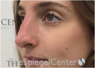 Non-Surgical Rhinoplasty / Nose Filler Before & After Gallery - Patient 283814 - Image 4