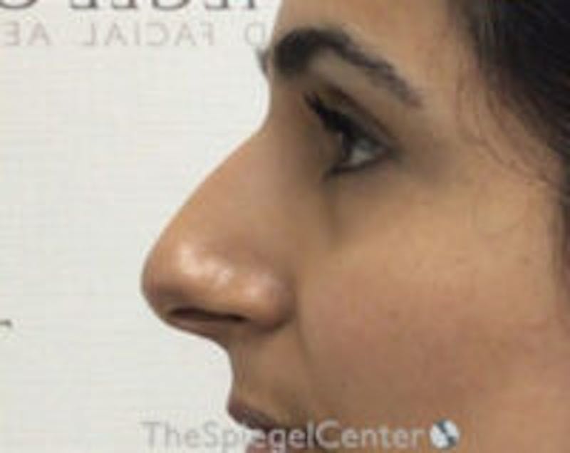 Non-Surgical Rhinoplasty / Nose Filler Before & After Gallery - Patient 313591 - Image 3
