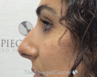 Non-Surgical Rhinoplasty / Nose Filler Before & After Gallery - Patient 313591 - Image 4