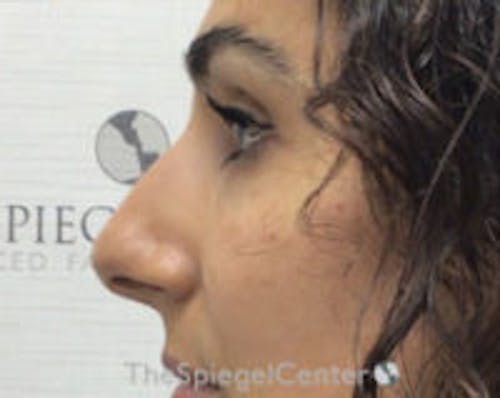 Non-Surgical Rhinoplasty / Nose Filler Before & After Gallery - Patient 313591 - Image 4