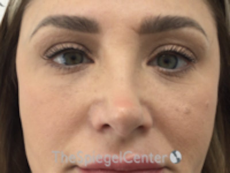Non-Surgical Rhinoplasty / Nose Filler Before & After Gallery - Patient 320717 - Image 1
