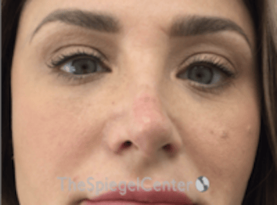 Non-Surgical Rhinoplasty / Nose Filler Before & After Gallery - Patient 320717 - Image 2