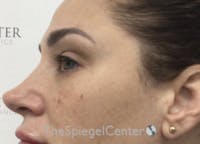 Non-Surgical Rhinoplasty / Nose Filler Before & After Gallery - Patient 320717 - Image 3