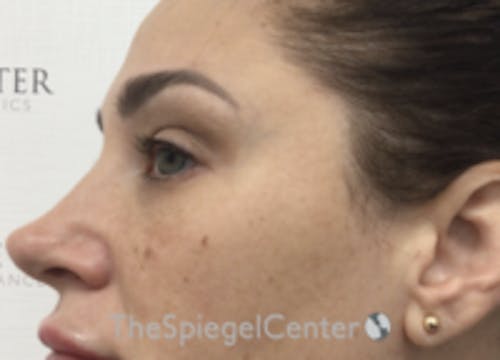 Non-Surgical Rhinoplasty / Nose Filler Before & After Gallery - Patient 320717 - Image 3