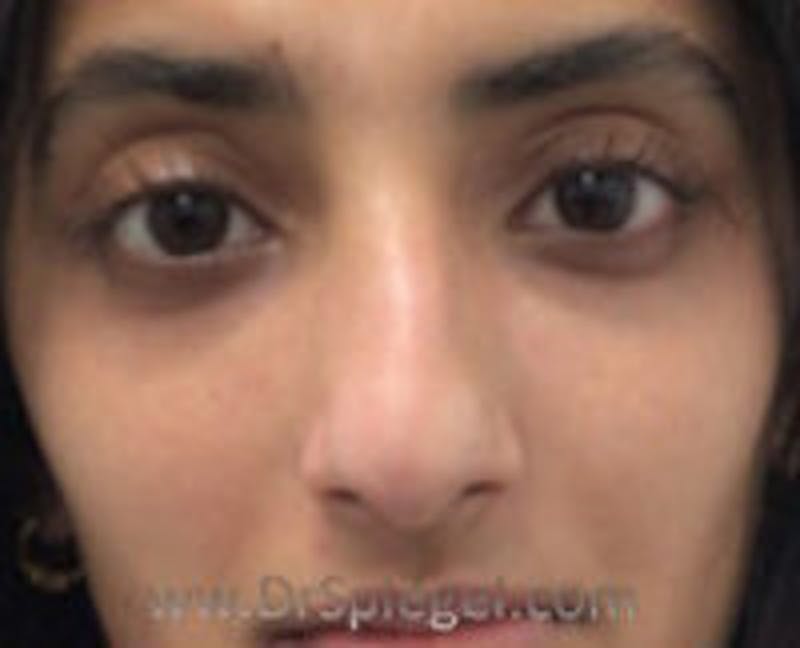 Non-Surgical Rhinoplasty / Nose Filler Before & After Gallery - Patient 420906 - Image 1
