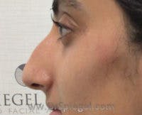 Non-Surgical Rhinoplasty / Nose Filler Before & After Gallery - Patient 420906 - Image 3