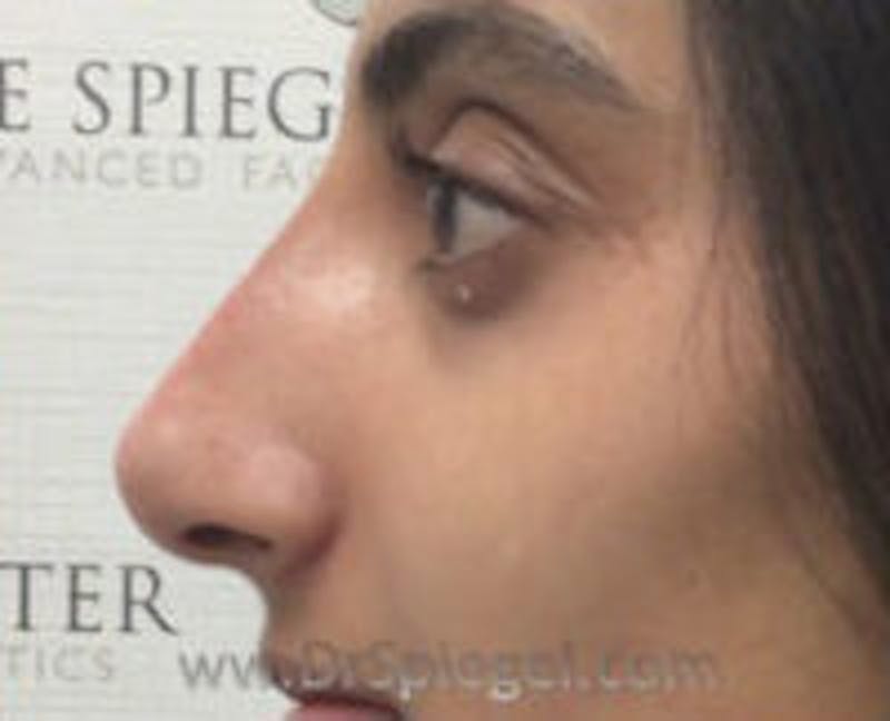 Non-Surgical Rhinoplasty / Nose Filler Before & After Gallery - Patient 420906 - Image 4