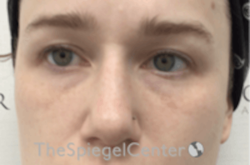 Non-Surgical Rhinoplasty / Nose Filler Before & After Gallery - Patient 392233 - Image 1