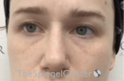 Non-Surgical Rhinoplasty / Nose Filler Before & After Gallery - Patient 392233 - Image 1