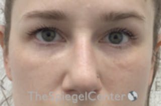 Non-Surgical Rhinoplasty / Nose Filler Before & After Gallery - Patient 392233 - Image 2