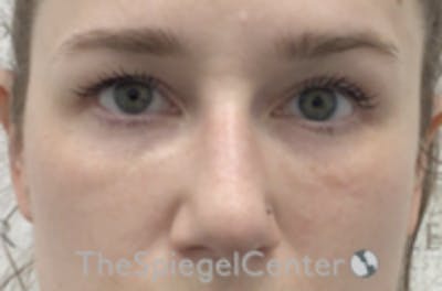 Non-Surgical Rhinoplasty / Nose Filler Before & After Gallery - Patient 392233 - Image 2