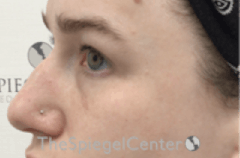 Non-Surgical Rhinoplasty / Nose Filler Before & After Gallery - Patient 392233 - Image 3