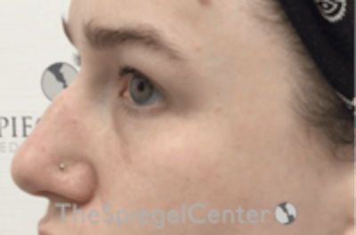 Non-Surgical Rhinoplasty / Nose Filler Before & After Gallery - Patient 392233 - Image 3