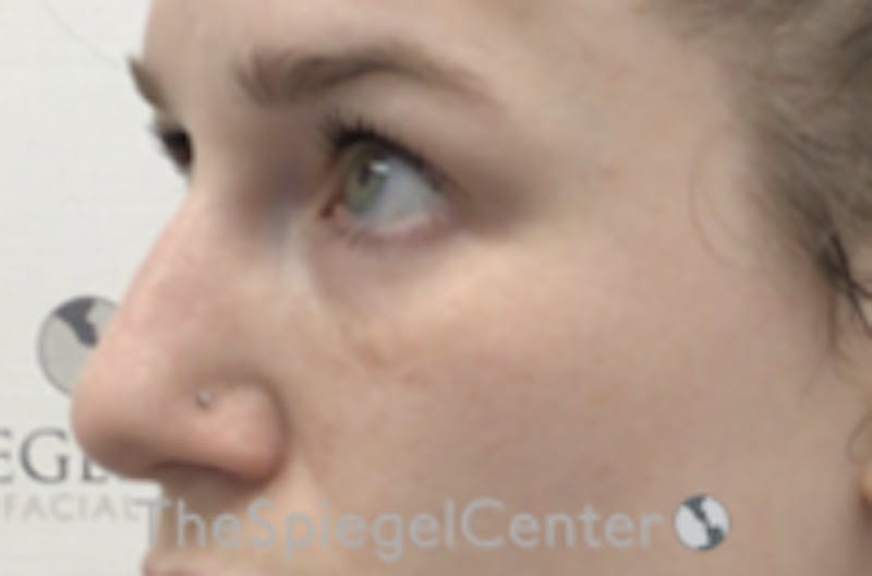Non-Surgical Rhinoplasty / Nose Filler Before & After Gallery - Patient 392233 - Image 4