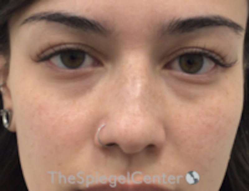 Non-Surgical Rhinoplasty / Nose Filler Before & After Gallery - Patient 350101 - Image 1