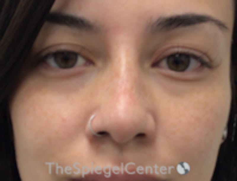 Non-Surgical Rhinoplasty / Nose Filler Before & After Gallery - Patient 350101 - Image 2
