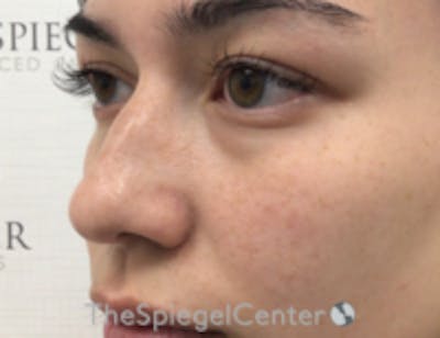 Non-Surgical Rhinoplasty / Nose Filler Before & After Gallery - Patient 350101 - Image 3