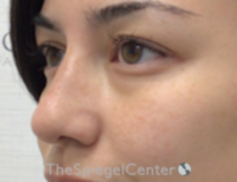 Non-Surgical Rhinoplasty / Nose Filler Before & After Gallery - Patient 350101 - Image 4