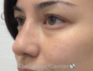 Non-Surgical Rhinoplasty / Nose Filler Before & After Gallery - Patient 350101 - Image 4