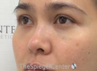 Non-Surgical Rhinoplasty / Nose Filler Before & After Gallery - Patient 333777 - Image 3