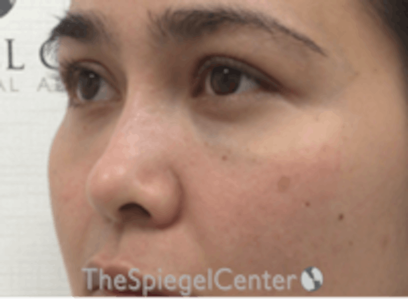 Non-Surgical Rhinoplasty / Nose Filler Before & After Gallery - Patient 333777 - Image 4