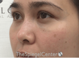 Non-Surgical Rhinoplasty / Nose Filler Before & After Gallery - Patient 333777 - Image 4