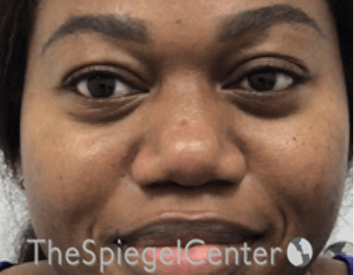 Non-Surgical Rhinoplasty / Nose Filler Before & After Gallery - Patient 280213 - Image 1