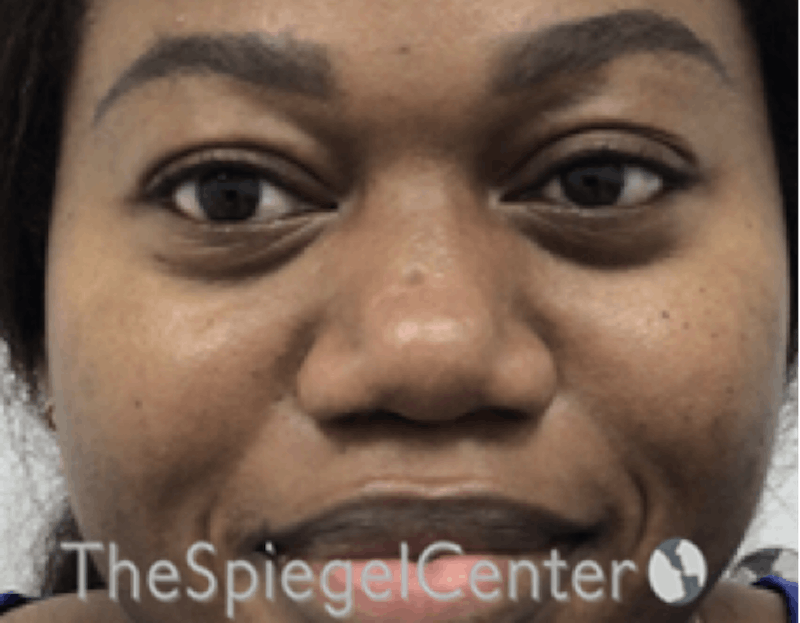 Non-Surgical Rhinoplasty / Nose Filler Before & After Gallery - Patient 280213 - Image 1