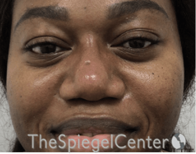 Non-Surgical Rhinoplasty / Nose Filler Before & After Gallery - Patient 280213 - Image 2