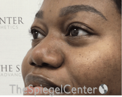Non-Surgical Rhinoplasty / Nose Filler Before & After Gallery - Patient 280213 - Image 3