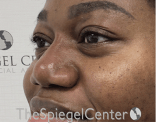 Non-Surgical Rhinoplasty / Nose Filler Before & After Gallery - Patient 280213 - Image 4