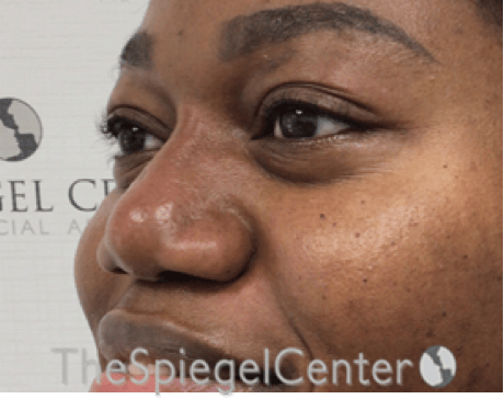 Non-Surgical Rhinoplasty / Nose Filler Before & After Gallery - Patient 280213 - Image 4