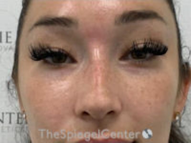 Non-Surgical Rhinoplasty / Nose Filler Before & After Gallery - Patient 279385 - Image 1