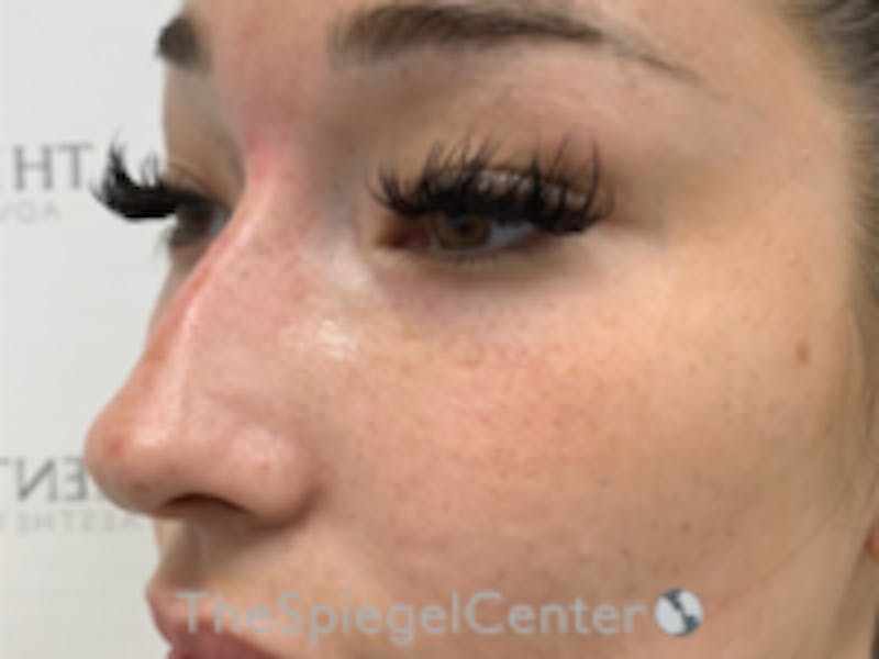 Non-Surgical Rhinoplasty / Nose Filler Before & After Gallery - Patient 279385 - Image 3