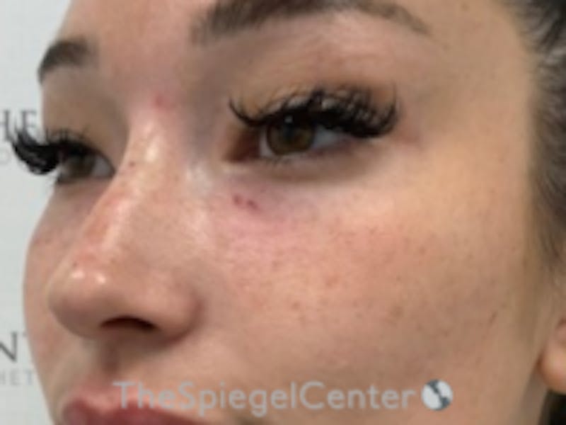 Non-Surgical Rhinoplasty / Nose Filler Before & After Gallery - Patient 279385 - Image 4