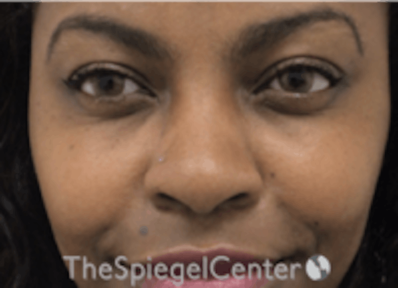 Non-Surgical Rhinoplasty / Nose Filler Before & After Gallery - Patient 412545 - Image 1