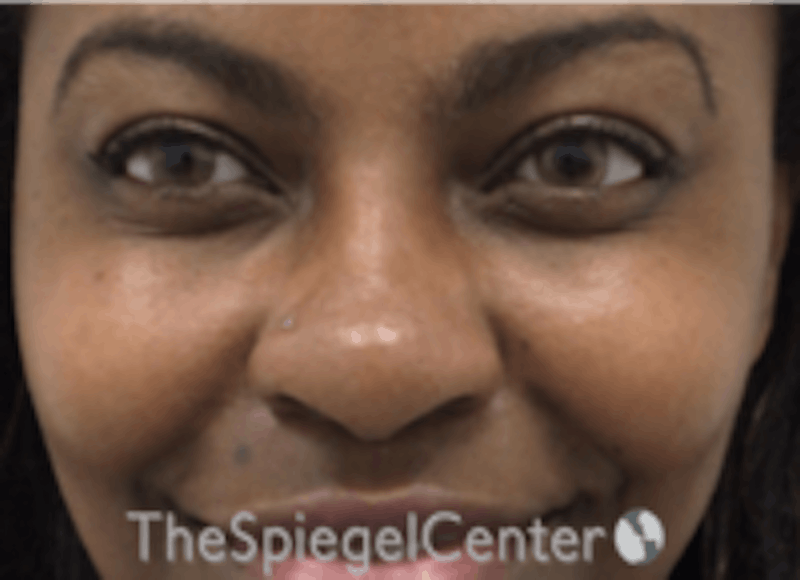 Non-Surgical Rhinoplasty / Nose Filler Before & After Gallery - Patient 412545 - Image 2