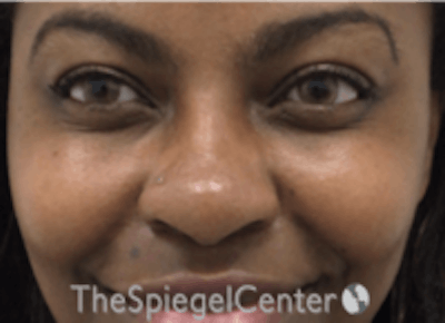 Non-Surgical Rhinoplasty / Nose Filler Before & After Gallery - Patient 412545 - Image 2