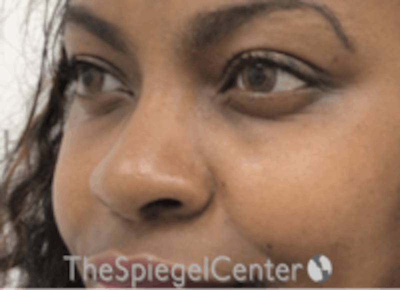 Non-Surgical Rhinoplasty / Nose Filler Before & After Gallery - Patient 412545 - Image 3