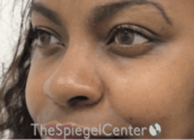Non-Surgical Rhinoplasty / Nose Filler Before & After Gallery - Patient 412545 - Image 3