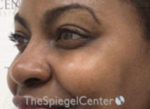 Non-Surgical Rhinoplasty / Nose Filler Before & After Gallery - Patient 412545 - Image 4