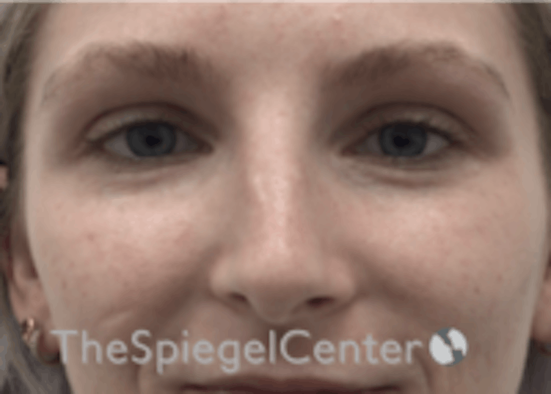 Non-Surgical Rhinoplasty / Nose Filler Before & After Gallery - Patient 100390 - Image 1