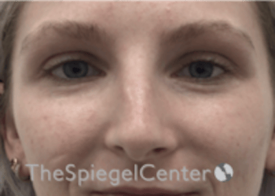 Non-Surgical Rhinoplasty / Nose Filler Before & After Gallery - Patient 100390 - Image 1