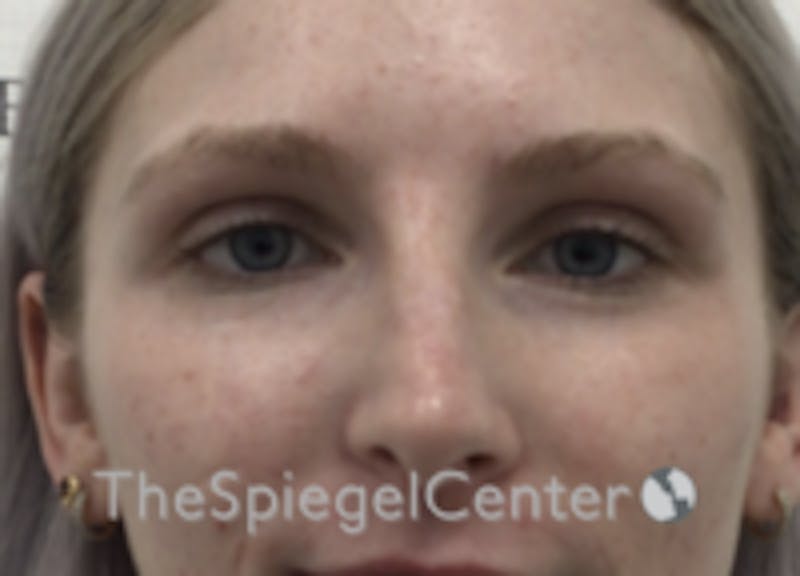 Non-Surgical Rhinoplasty / Nose Filler Before & After Gallery - Patient 100390 - Image 2