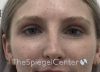 Non-Surgical Rhinoplasty / Nose Filler Before & After Gallery - Patient 100390 - Image 2