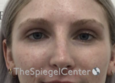 Non-Surgical Rhinoplasty / Nose Filler Before & After Gallery - Patient 100390 - Image 2