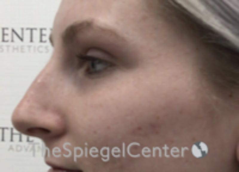 Non-Surgical Rhinoplasty / Nose Filler Before & After Gallery - Patient 100390 - Image 3