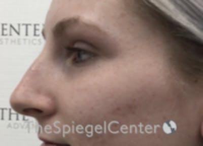 Non-Surgical Rhinoplasty / Nose Filler Before & After Gallery - Patient 100390 - Image 3