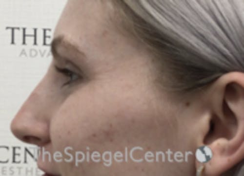 Non-Surgical Rhinoplasty / Nose Filler Before & After Gallery - Patient 100390 - Image 4